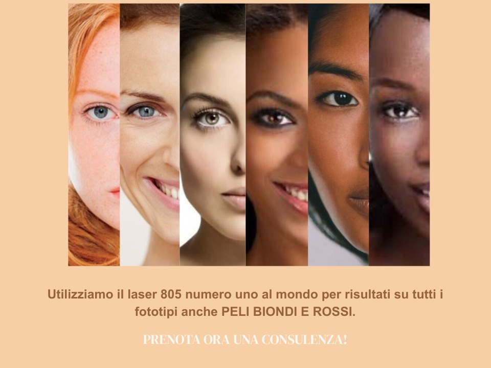 Diodo laser epilazione